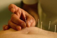 acupuntura en vigo